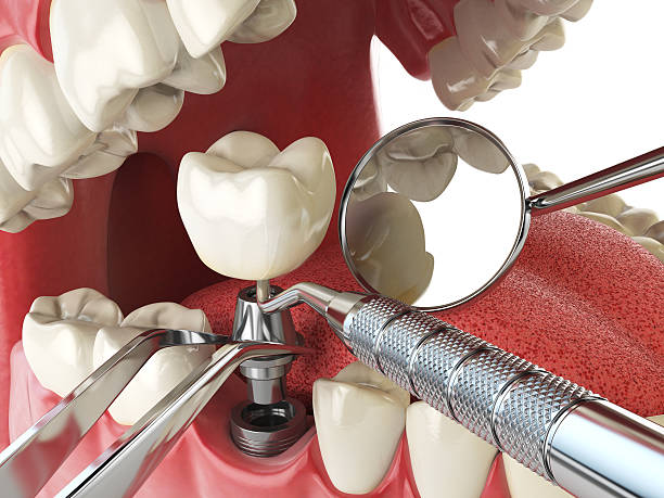 Best Dentist for Tooth Abscess  in Crooked Lake Park, FL